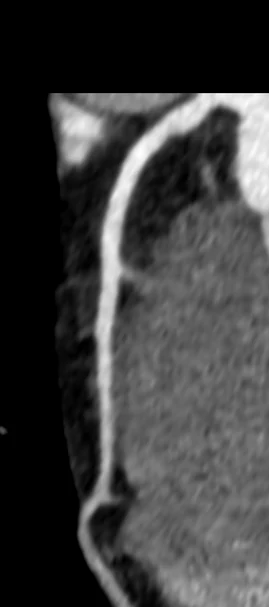 Koronararterie in einer CT-Darstellung